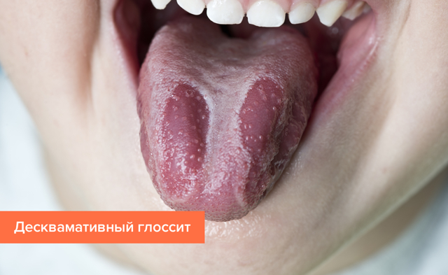 Глоссит что это такое, симптомы и лечение