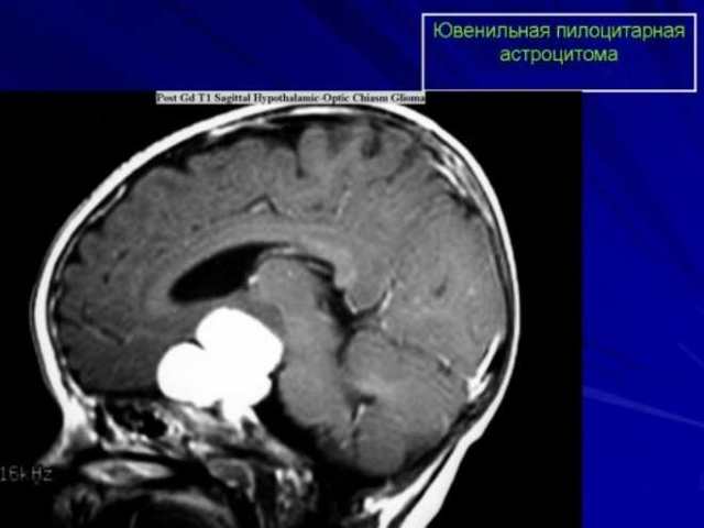 Астроцитома головного мозга: причины и лечение, прогноз для жизни