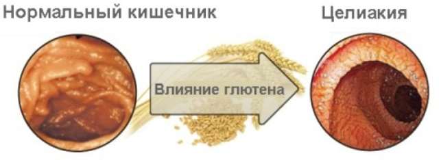 Целиакия, что это такое