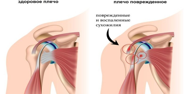Как выглядит бурсит плечевого сустава, его первые симптомы и варианты лечения