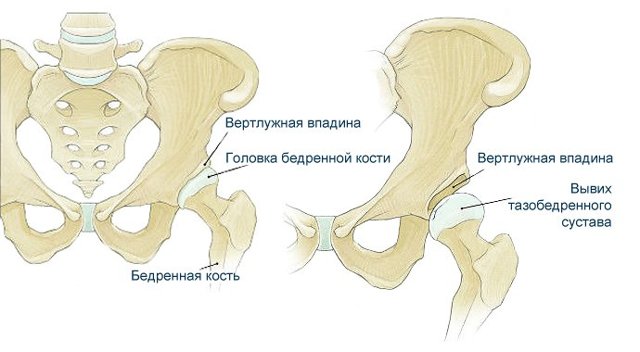Дисплазия тазобедренных суставов у новорожденных детей (грудничков)