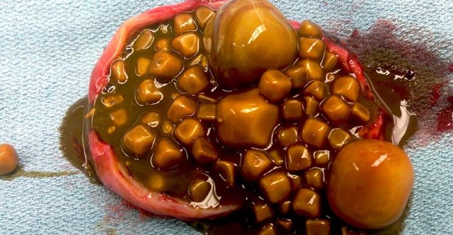 Симптомы желчекаменной болезни, лечение без операции и диета