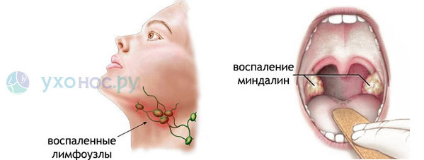 Аденовирусная инфекция: симптомы и рекомендации по лечению в домашних условиях