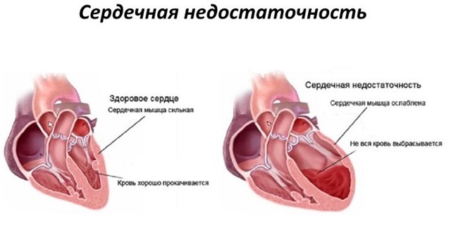 Лечение гипертонии 2 степени, симптомы и причины возникновения