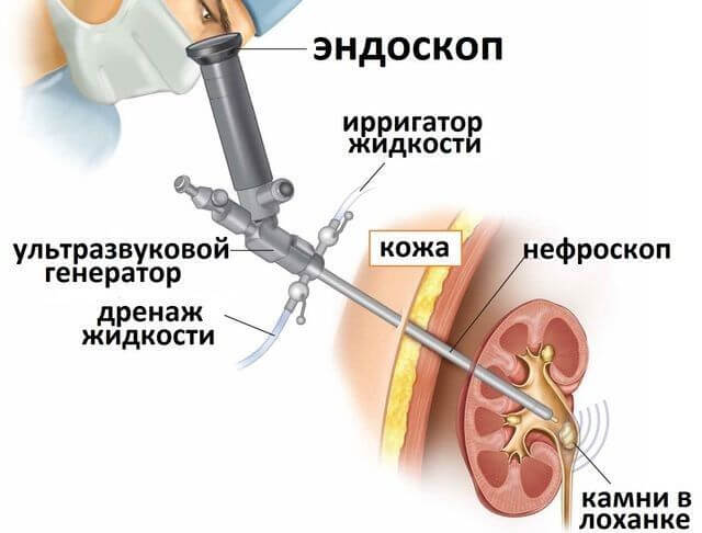 Как вывести камень из мочеточнике в домашних условиях