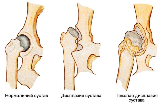 Дисплазия тазобедренных суставов у новорожденных детей (грудничков)
