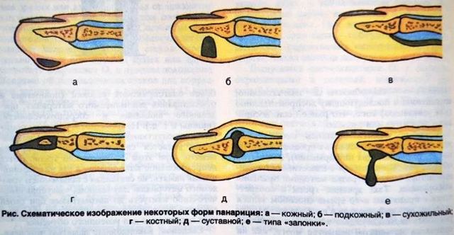Панариций пальца на руке: симптомы, фото и способы лечения