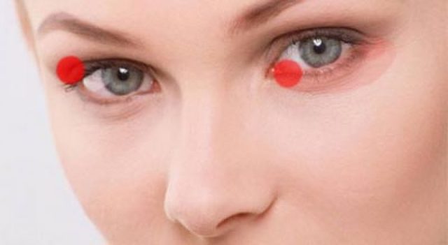 Блефарит: что это такое? Фото, симптомы и лечение