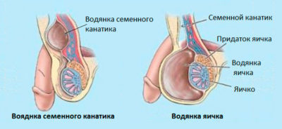 Водянка яичка: симптомы и лечение, отзывы мужчин