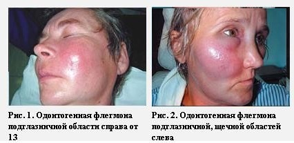 Особенности флегмоны, методы ее лечения и профилактика