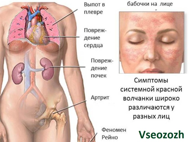 Красная волчанка, что это за болезнь? Фото, лечение и продолжительность жизни