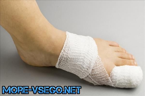 Вросший ноготь на большом пальце ноги лечение в домашних условиях