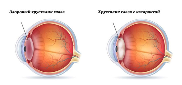 Симптомы катаракты, лечение и способы профилактики