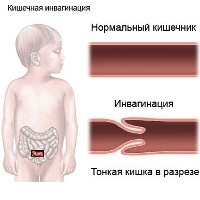 Геморрагический васкулит: фото, причины и способы лечения у детей и взрослых