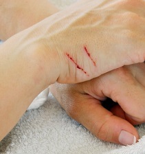 Болезнь кошачьих царапин: проявления болезни и способы лечения
