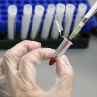 Первые симптомы артрита коленного сустава, лечение и правила профилактики