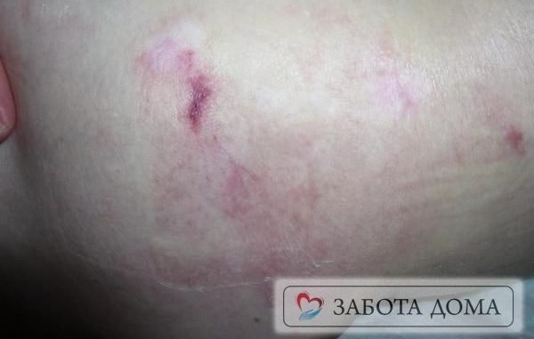 Пролежни у лежачих больных: лечение и профилактика, фото в начальной стадии