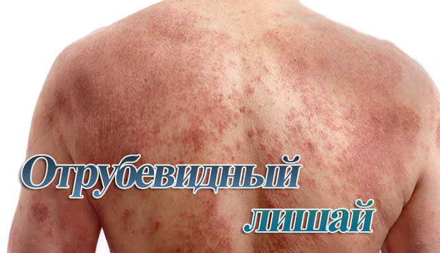 Отрубевидный лишай у человека: симптомы и эффективное лечение