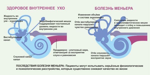 Болезнь Меньера: что это такое? Симптомы и лечение