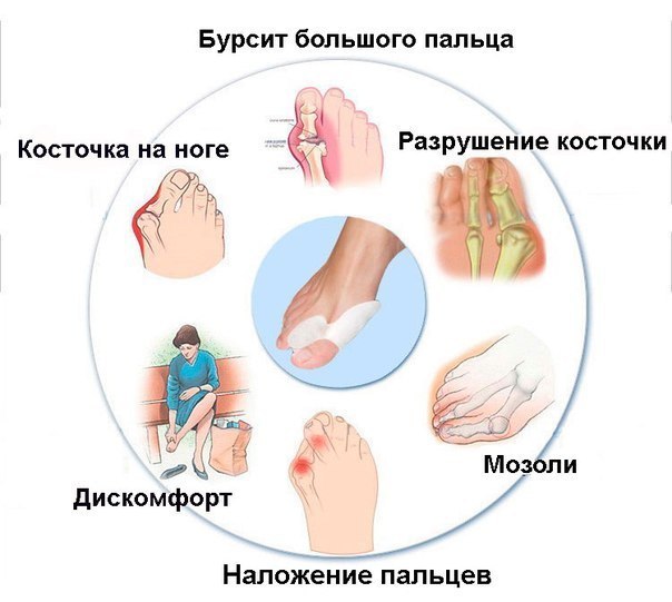 Бурсит большого пальца стопы: симптомы и схема лечения