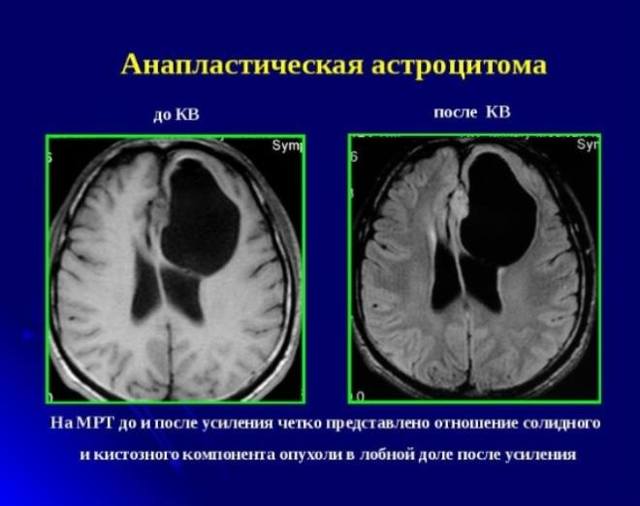 Астроцитома головного мозга: причины и лечение, прогноз для жизни