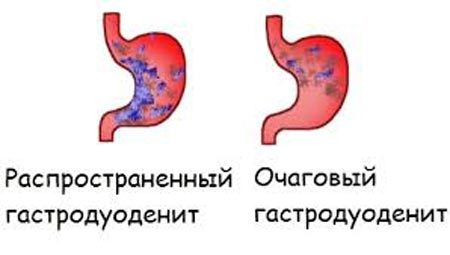 Гастродуоденит: что это такое, симптомы и лечение