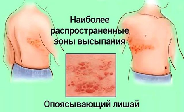Опоясывающий герпес, симптомы и лечение у взрослых