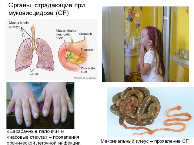 Симптомы муковисцидоза, причины и лечение