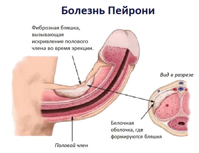 Лечение болезни Пейрони у мужчин, причины и первые симптомы