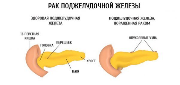 Киста поджелудочной железы: симптомы, причины и лечение