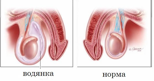 Водянка яичка: симптомы и лечение, отзывы мужчин
