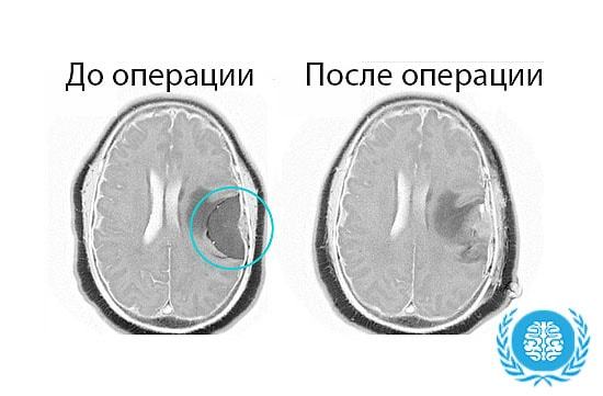 Симптомы и лечение менингиомы головного мозга — прогноз и последствия после удаления опухоли
