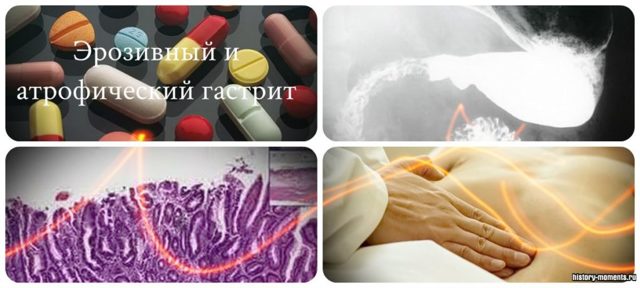 Атрофический гастрит: симптомы и схема лечения