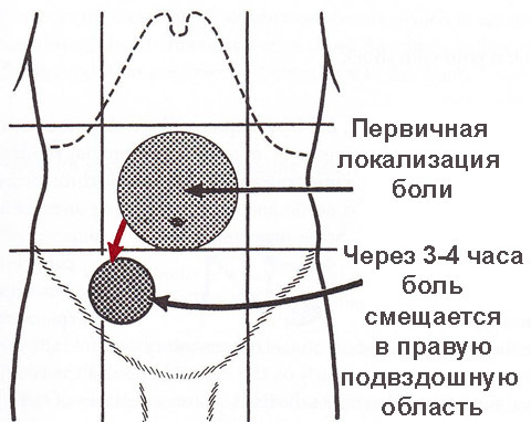Симптомы аппендицита, первые признаки у взрослых и детей