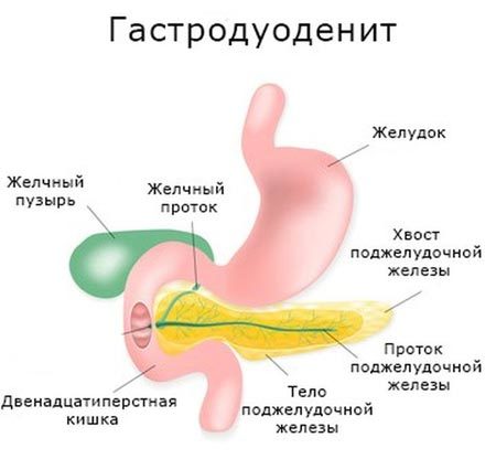 Гастродуоденит: что это такое, симптомы и лечение