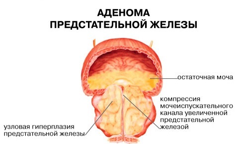 Аденома предстательной железы: симптомы, лечение и прогноз