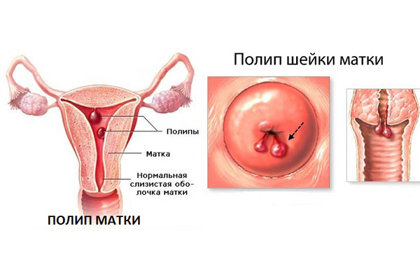 Полипы в матке – опасно ли это? Симптомы и удаление полипов