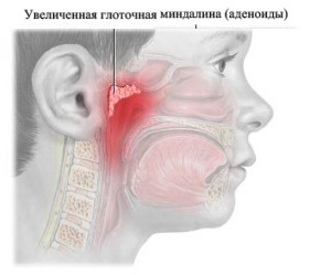 Аденоидит у детей: фото, симптомы и рекомендации по лечению