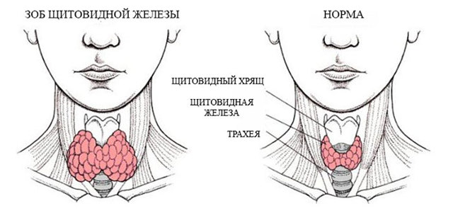 Узловой зоб, что это такое? Как лечить и какие симптомы
