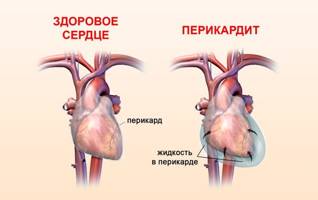 Перикардит, что это такое? Причины и способы лечения