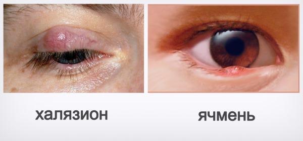 Что такое халязион: симптомы и лечение