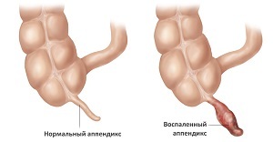 Симптомы аппендицита, первые признаки у взрослых и детей