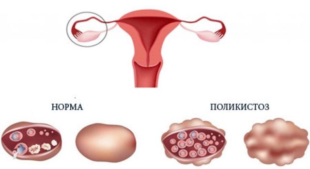 Поликистоз яичников, что это такое? Симптомы и лечение