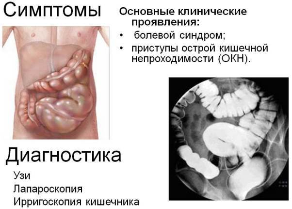 Что делать при кишечной непроходимости?