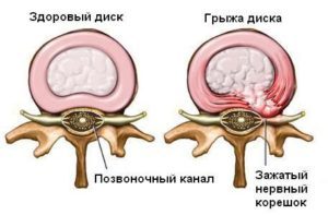 Грыжа поясничного отдела позвоночника: симптомы и лечение