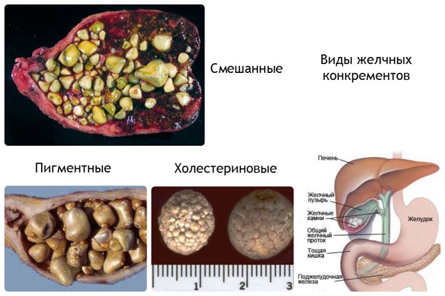 Симптомы желчекаменной болезни, лечение без операции и диета