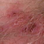 Как лечить герпес в интимной зоне у женщин, симптомы и фото высыпаний