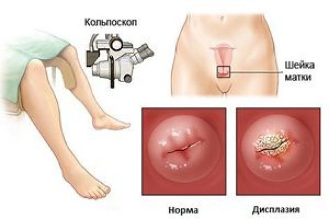 Лейкоплакия шейки матки: что это такое? Симптомы и лечение