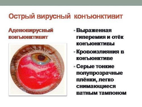 Аллергический конъюнктивит у взрослых: симптомы и лечение