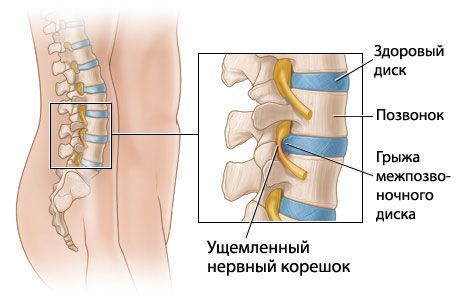 Грыжа поясничного отдела позвоночника: симптомы и лечение